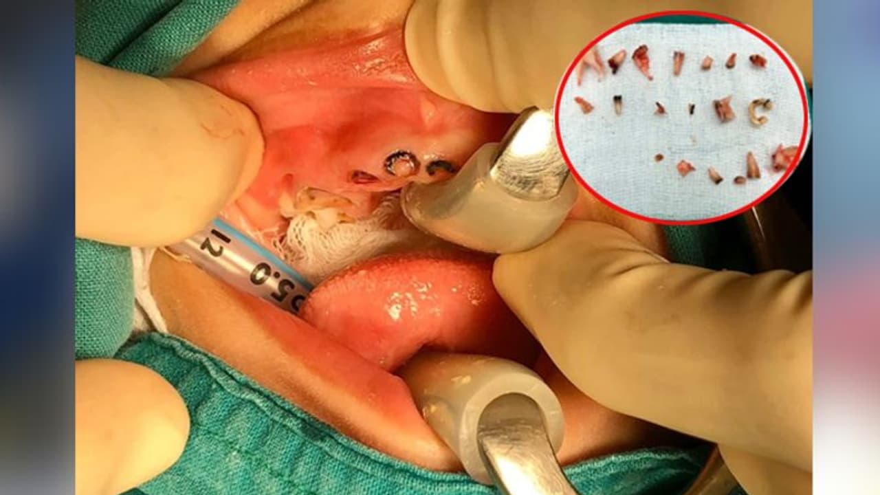 4 साल के बच्चे के मुंह से आती थी तेज बदबू, अंदर झांका तो दांतों में लगे थे बड़े बड़े कीड़े 4 साल के बच्चे के मुंह से आती थी तेज बदबू, अंदर झांका तो दांतों में लगे थे बड़े बड़े कीड़े