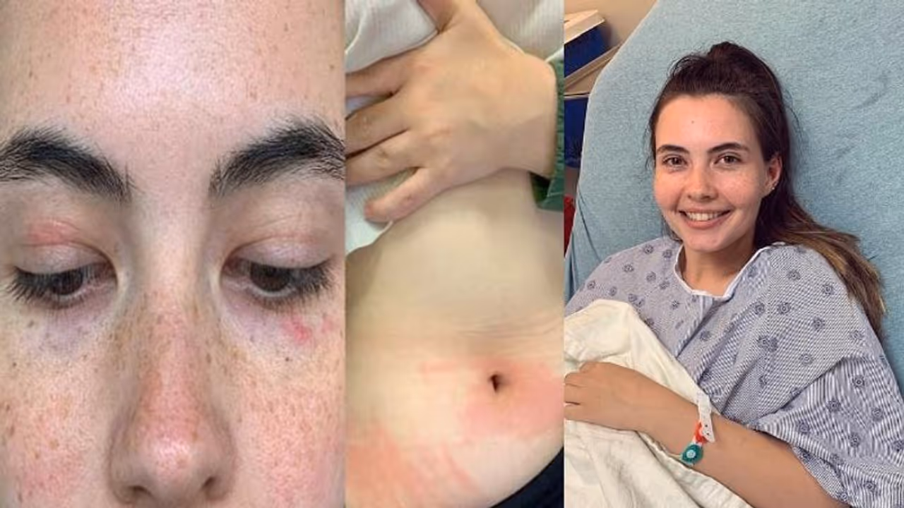 മാസത്തില്‍ രണ്ടുതവണ കുളി, സ്വന്തം തുപ്പലും കണ്ണുനീരും വരെ അലർജി; അപൂർവ രോഗവുമായി ഇരുപത്തൊന്നുകാരി