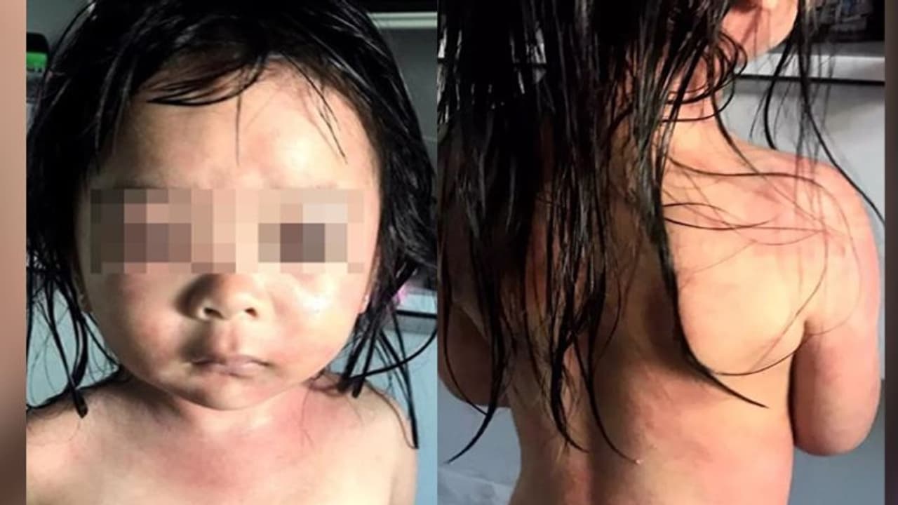 सस्ते क्लोरीन पाउडर से करते थे स्विमिंग पूल की सफाई, पानी में ऐसे जल गई बच्ची की चमड़ी सस्ते क्लोरीन पाउडर से करते थे स्विमिंग पूल की सफाई, पानी में ऐसे जल गई बच्ची की चमड़ी