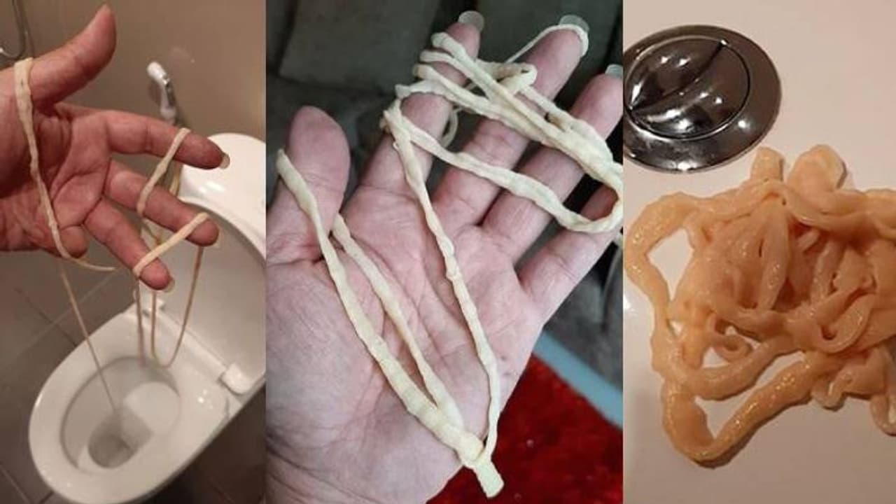 ശൗചാലയത്തിലെത്തിയ യുവാവ് മലദ്വാരത്തിൽനിന്ന് പുറത്തെടുത്തത് 32 അടി നീളമുള്ള വിര ശൗചാലയത്തിലെത്തിയ യുവാവ് മലദ്വാരത്തിൽനിന്ന് പുറത്തെടുത്തത് 32 അടി നീളമുള്ള വിര