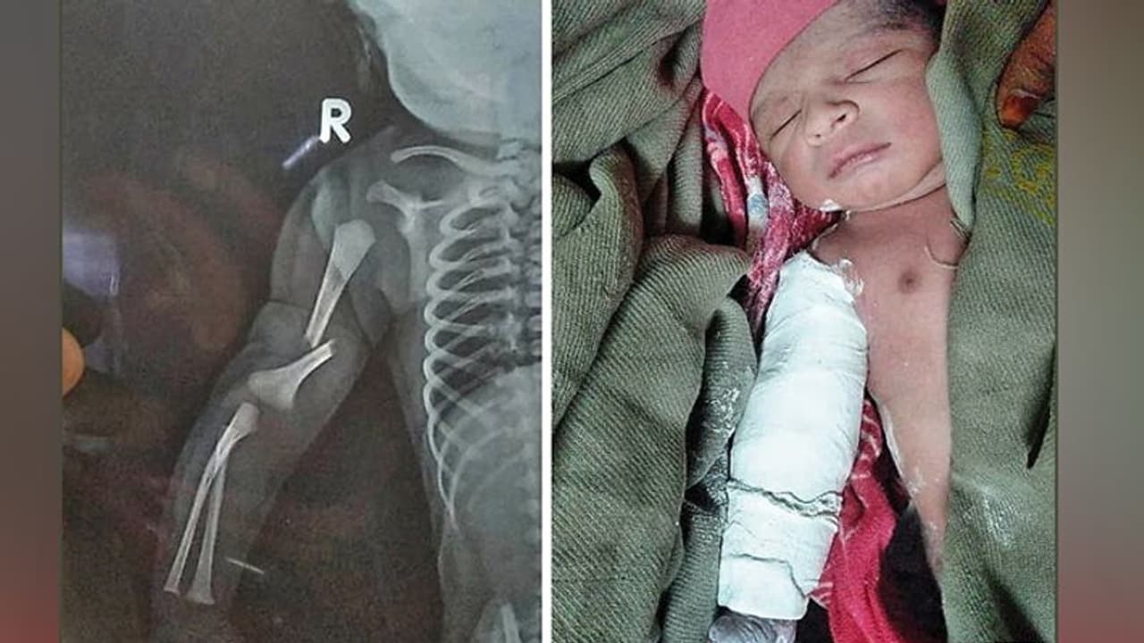 नर्स की लापरवाही से तीन जगह से टूटा मां के 'जिगर' का हाथ, वो तड़पता है, दर्द मां को होता है नर्स की लापरवाही से तीन जगह से टूटा मां के 'जिगर' का हाथ, वो तड़पता है, दर्द मां को होता है