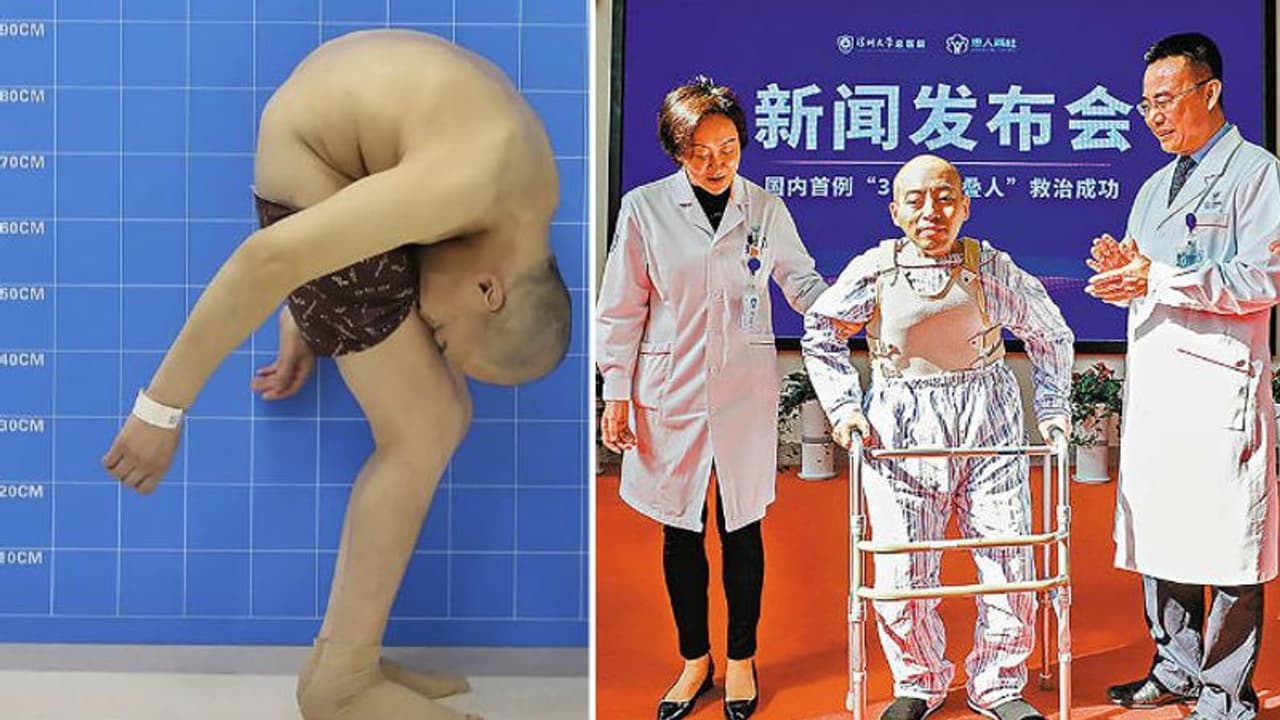 20 വര്ഷമായി മടക്കുമായി ജീവിച്ച മനുഷ്യന് ഒടുവില് നിവര്ന്നു! 20 വര്ഷമായി മടക്കുമായി ജീവിച്ച മനുഷ്യന് ഒടുവില് നിവര്ന്നു!