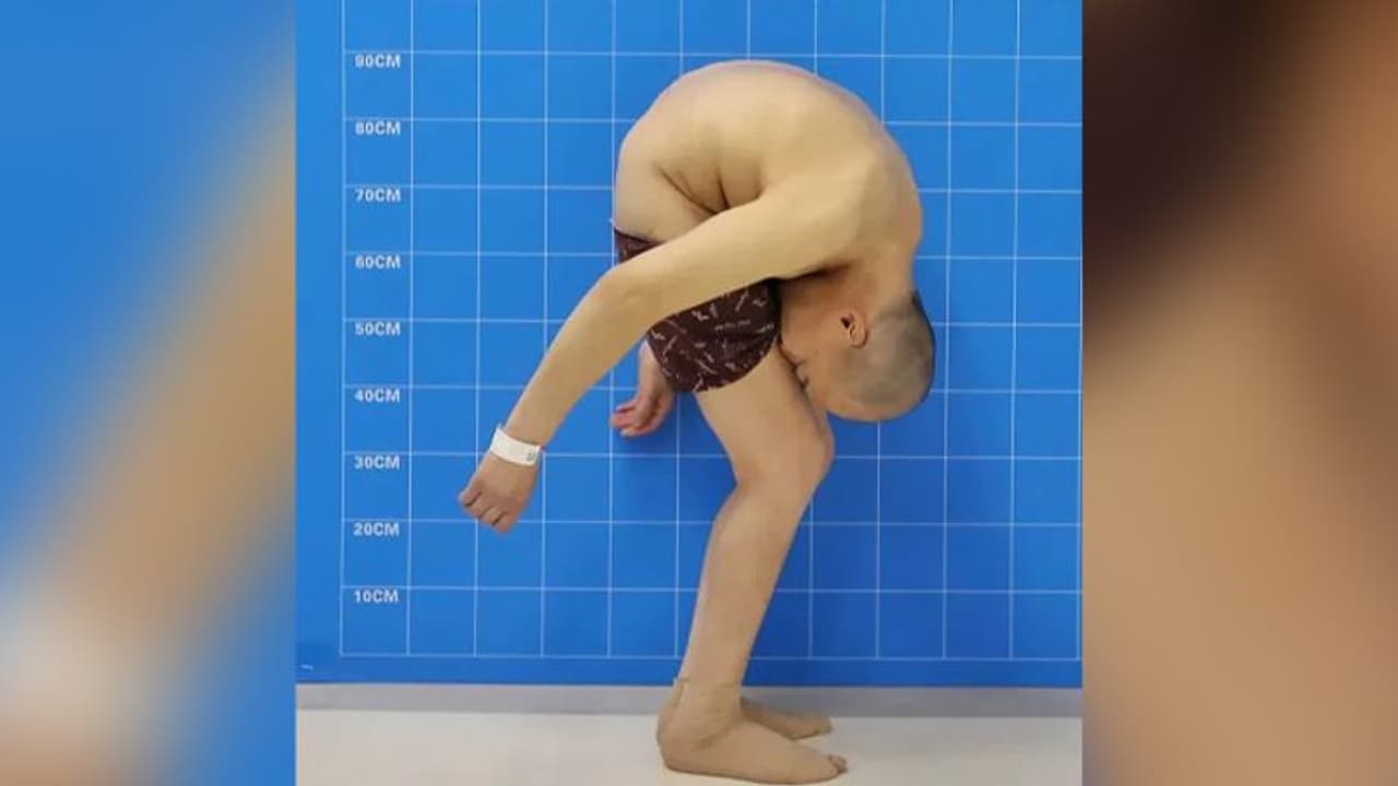 28 साल श्रापित जिंदगी जीता रहा शख्स, डॉक्टरों ने भगवान बन बदल दी जिंदगी 28 साल श्रापित जिंदगी जीता रहा शख्स, डॉक्टरों ने भगवान बन बदल दी जिंदगी