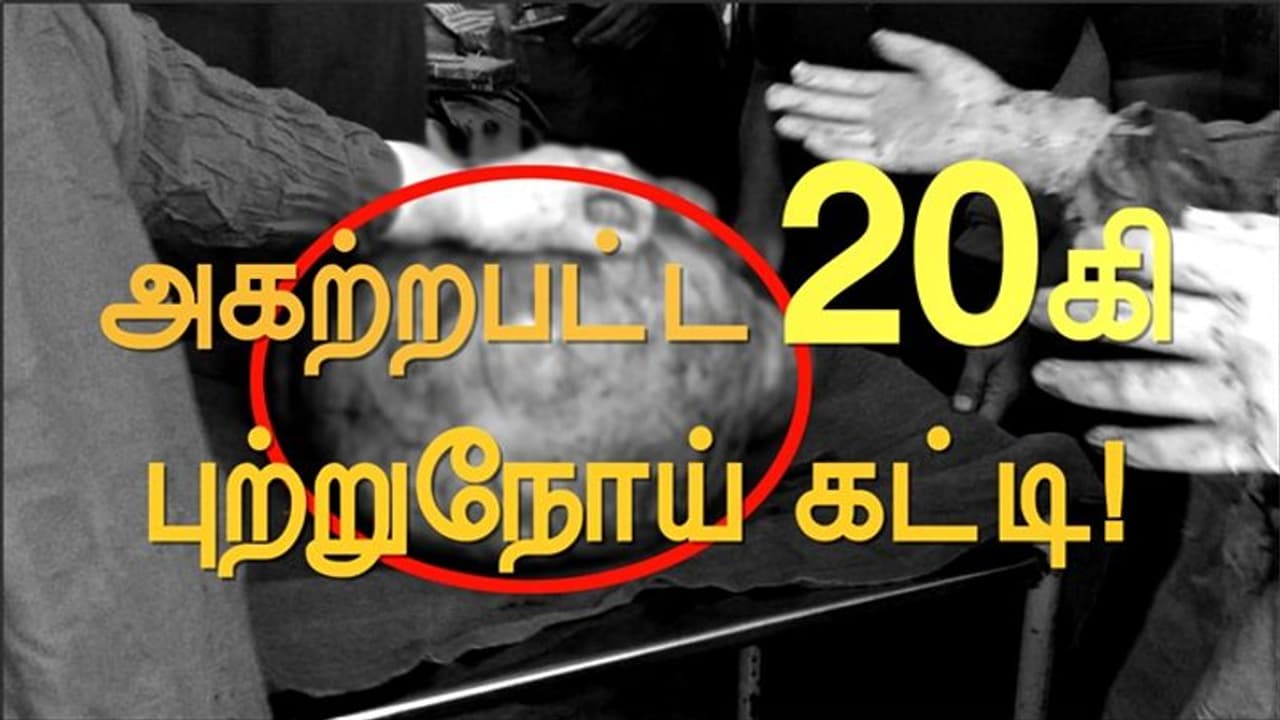 முதல் முறையாக...175 வருடத்தில் எழும்பூர் மருத்துவமனையில்... 20 கிலோ கேன்சர் கட்டி அகற்றம்...! முதல் முறையாக...175 வருடத்தில் எழும்பூர் மருத்துவமனையில்... 20 கிலோ கேன்சர் கட்டி அகற்றம்...!