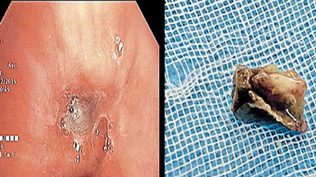 വര്ഷങ്ങളായി വിട്ടുമാറാതെ ന്യുമോണിയ; ശ്വാസകോശത്തില് നിന്ന് കണ്ടെത്തിയത് മീന്തല വര്ഷങ്ങളായി വിട്ടുമാറാതെ ന്യുമോണിയ; ശ്വാസകോശത്തില് നിന്ന് കണ്ടെത്തിയത് മീന്തല