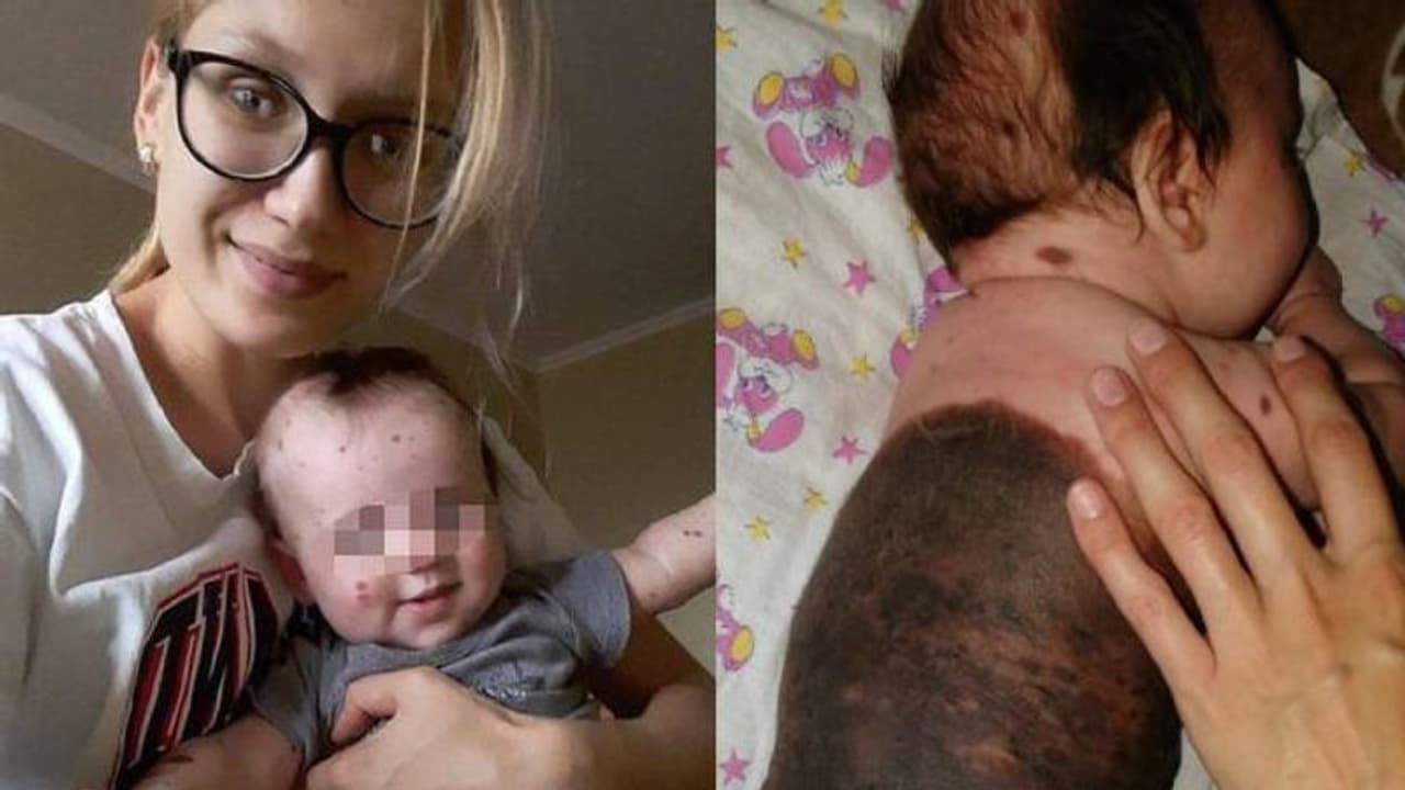 ശരീരത്തിന്റെ മുക്കാല് ഭാഗവും മറുക്; അമ്മയോട് കുഞ്ഞിനെ കൊന്ന് കളയാന് ആവശ്യപ്പെട്ട് സോഷ്യല് മീഡിയ ശരീരത്തിന്റെ മുക്കാല് ഭാഗവും മറുക്; അമ്മയോട് കുഞ്ഞിനെ കൊന്ന് കളയാന് ആവശ്യപ്പെട്ട് സോഷ്യല് മീഡിയ