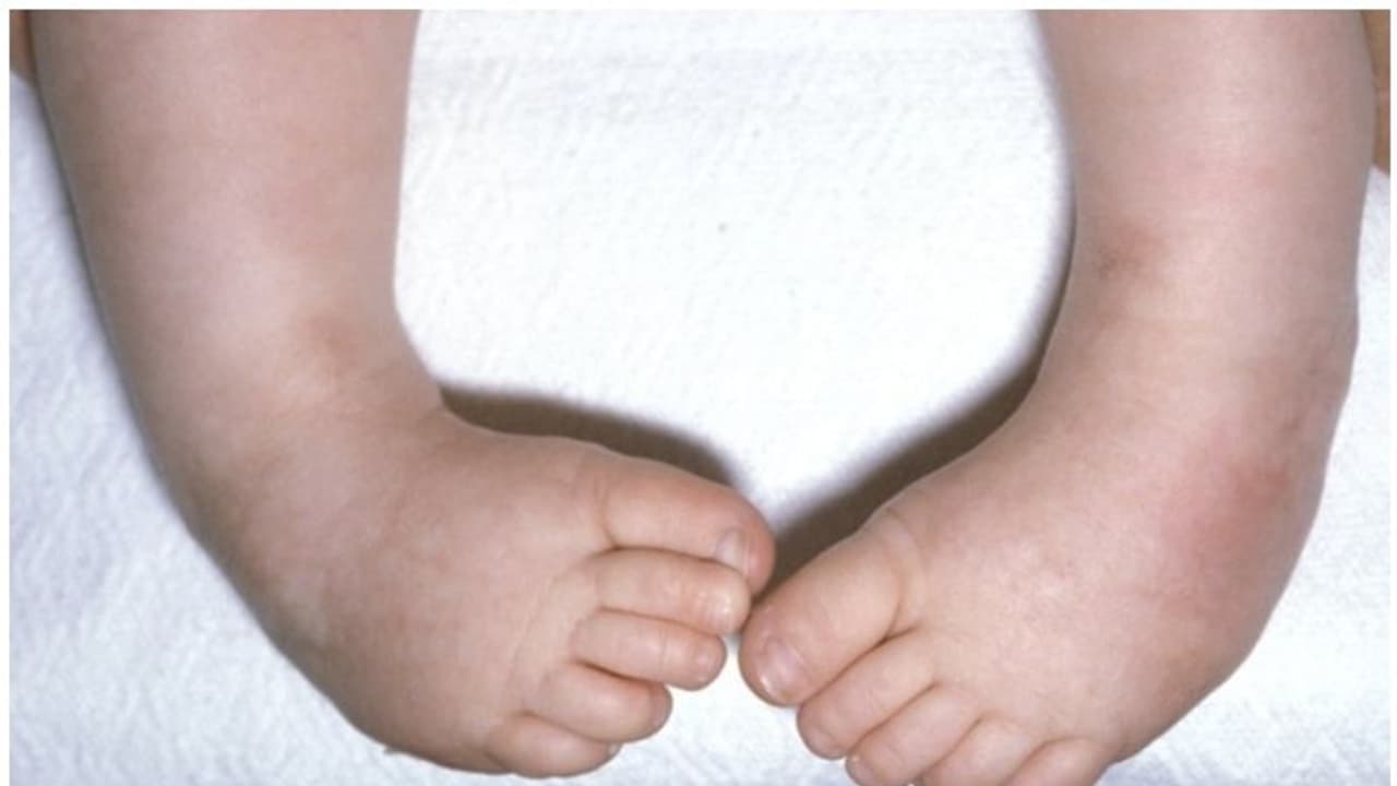കുഞ്ഞുങ്ങളുടെ കാല്പ്പാദത്തിലെ വളവ്; ഫലപ്രദമായ ചികിത്സയുമായി തിരുവനന്തപുരം മെഡിക്കല് കോളേജ് കുഞ്ഞുങ്ങളുടെ കാല്പ്പാദത്തിലെ വളവ്; ഫലപ്രദമായ ചികിത്സയുമായി തിരുവനന്തപുരം മെഡിക്കല് കോളേജ്
