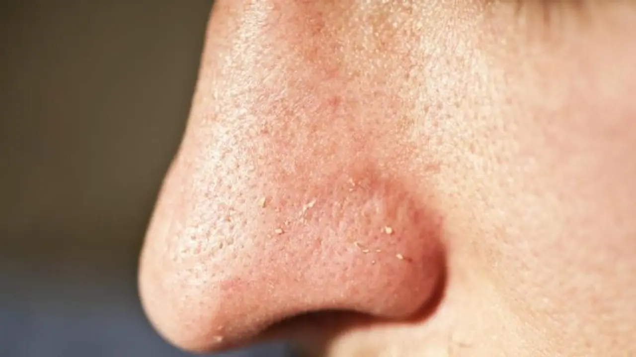 വൈറ്റ്ഹെഡ്സ് എങ്ങനെ ഒഴിവാക്കാം ? വീട്ടില് പരീക്ഷിക്കാവുന്ന ചില പൊടിക്കൈകള് നോക്കാം വൈറ്റ്ഹെഡ്സ് എങ്ങനെ ഒഴിവാക്കാം ? വീട്ടില് പരീക്ഷിക്കാവുന്ന ചില പൊടിക്കൈകള് നോക്കാം