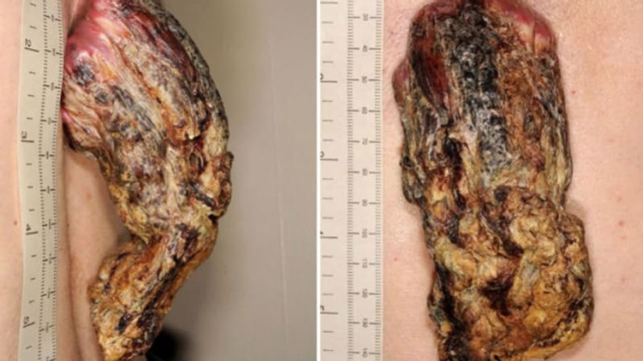 ചെറിയൊരു പാട് പോലെ വന്നു; മൂന്ന് വര്‍ഷം കൊണ്ട് മുതുകില്‍ വളര്‍ന്നത് കൊമ്പ്...