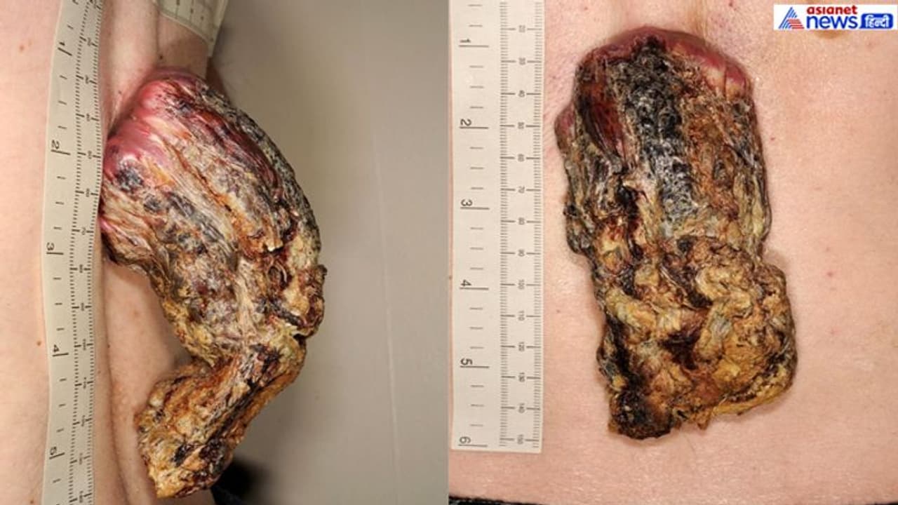 शख्स की पीठ पर अचानक उग आया बड़ा सा सींग, नजरअंदाज करने का हुआ खौफनाक अंजाम शख्स की पीठ पर अचानक उग आया बड़ा सा सींग, नजरअंदाज करने का हुआ खौफनाक अंजाम