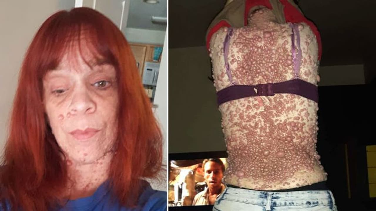 ശരീരമാകെ മുഴകള്; റോഡിലിറങ്ങിയാല് ആളുകളുടെ വെറുപ്പ് കാണണമെന്ന് യുവതി ശരീരമാകെ മുഴകള്; റോഡിലിറങ്ങിയാല് ആളുകളുടെ വെറുപ്പ് കാണണമെന്ന് യുവതി