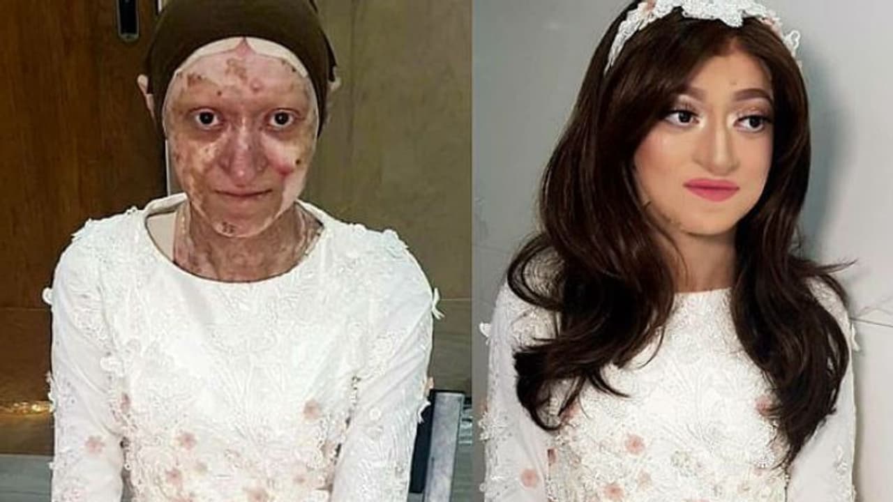 ശരീരം മുഴുവന് പഴുപ്പ് നിറഞ്ഞ കുമിളകള്; അറിയണം ഈ അപൂര്വ്വരോഗത്തെ കുറിച്ച് ശരീരം മുഴുവന് പഴുപ്പ് നിറഞ്ഞ കുമിളകള്; അറിയണം ഈ അപൂര്വ്വരോഗത്തെ കുറിച്ച്