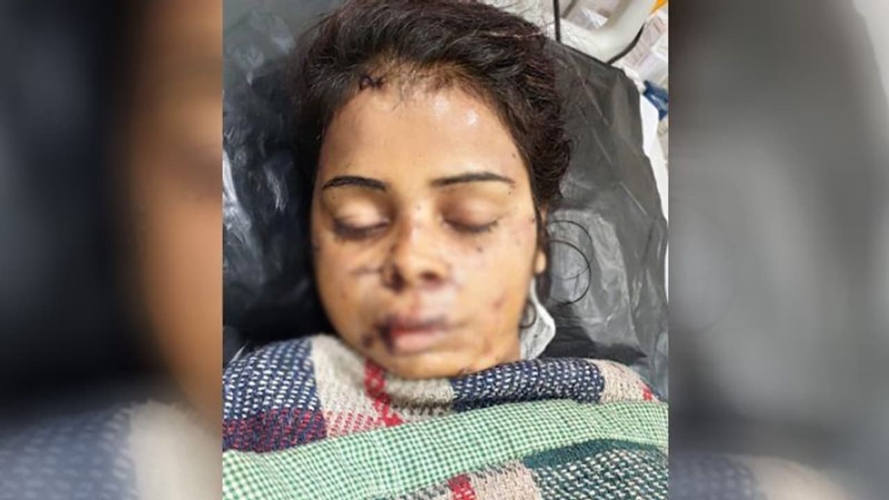 इसलिए बहू के शरीर पर किए 101 जख्म, डाक्टर को लगाने पड़े 300 टांके, कारण जानकर हो जाएंगे हैरान इसलिए बहू के शरीर पर किए 101 जख्म, डाक्टर को लगाने पड़े 300 टांके, कारण जानकर हो जाएंगे हैरान