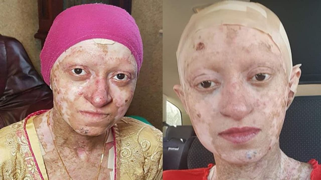 ചർമം പൊട്ടി പഴുപ്പ് വരും; ഭക്ഷണം പോലും കഴിക്കാൻ പറ്റാത്ത അവസ്ഥ; ജനിച്ച് അന്ന് മുതൽ ആസ്യയെ ഈ രോഗം അലട്ടുന്നു ചർമം പൊട്ടി പഴുപ്പ് വരും; ഭക്ഷണം പോലും കഴിക്കാൻ പറ്റാത്ത അവസ്ഥ; ജനിച്ച് അന്ന് മുതൽ ആസ്യയെ ഈ രോഗം അലട്ടുന്നു