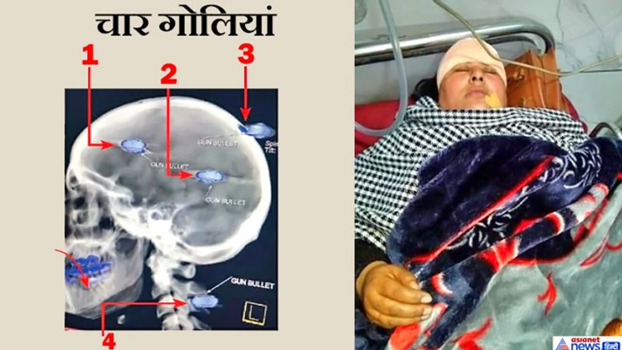 सिर में तीन और जबड़े में एक गोली लगने पर भी महिला खुद गाड़ी चलाकर घायल मां को लेकर हॉस्पिटल पहुंची सिर में तीन और जबड़े में एक गोली लगने पर भी महिला खुद गाड़ी चलाकर घायल मां को लेकर हॉस्पिटल पहुंची