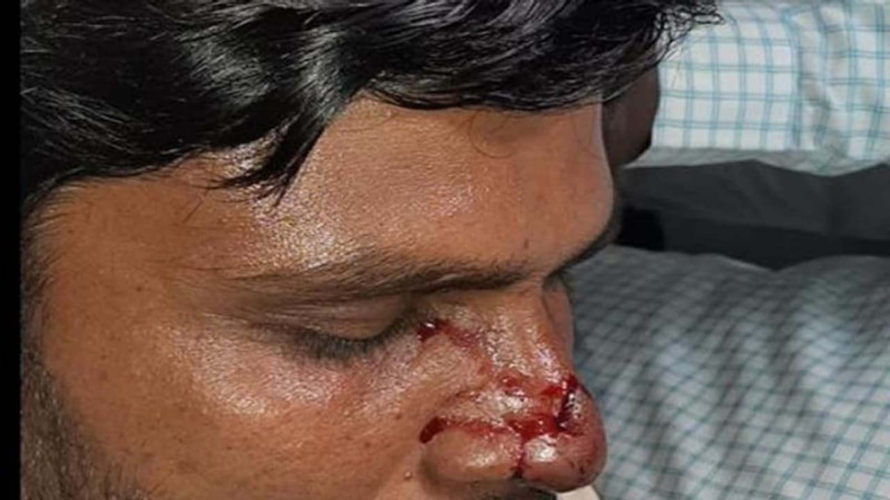 మున్సిపల్ ఎన్నికలు: టీఆర్ఎస్ అభ్యర్థి ముక్కు కొరికిన కాంగ్రెస్ అభ్యర్థి మున్సిపల్ ఎన్నికలు: టీఆర్ఎస్ అభ్యర్థి ముక్కు కొరికిన కాంగ్రెస్ అభ్యర్థి