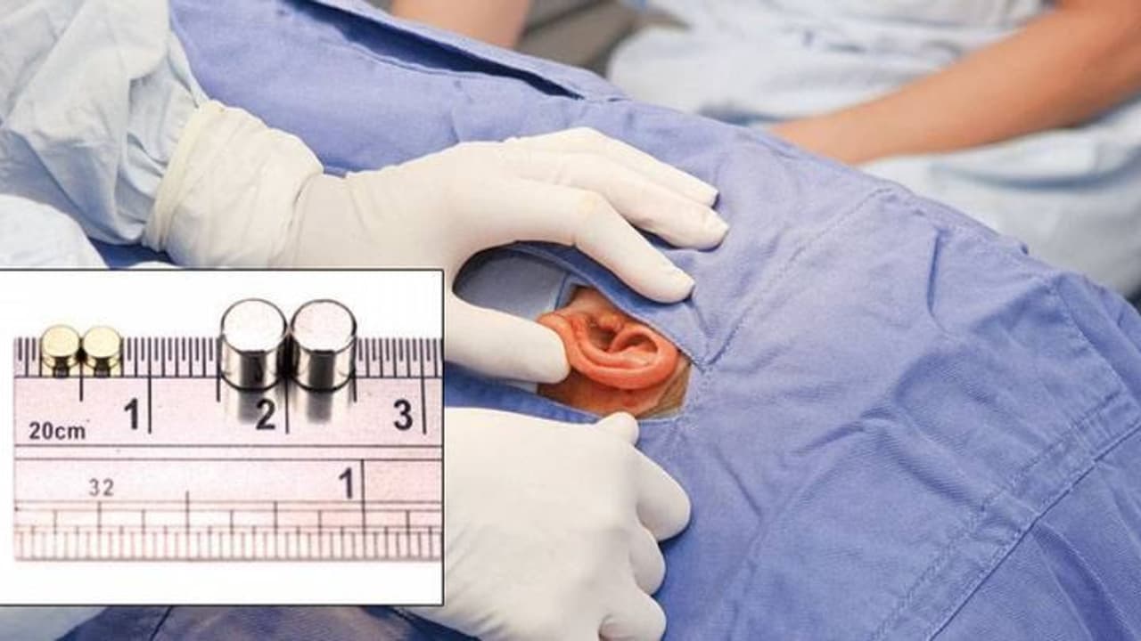 കോപ്പിയടിക്കാന് ഉപയോഗിച്ച ഉപകരണങ്ങള് ചെവിയ്ക്കുള്ളില് കുടുങ്ങി; 15 വിദ്യാര്ത്ഥികള് ശസ്ത്രക്രിയക്ക് വിധേയരായി കോപ്പിയടിക്കാന് ഉപയോഗിച്ച ഉപകരണങ്ങള് ചെവിയ്ക്കുള്ളില് കുടുങ്ങി; 15 വിദ്യാര്ത്ഥികള് ശസ്ത്രക്രിയക്ക് വിധേയരായി