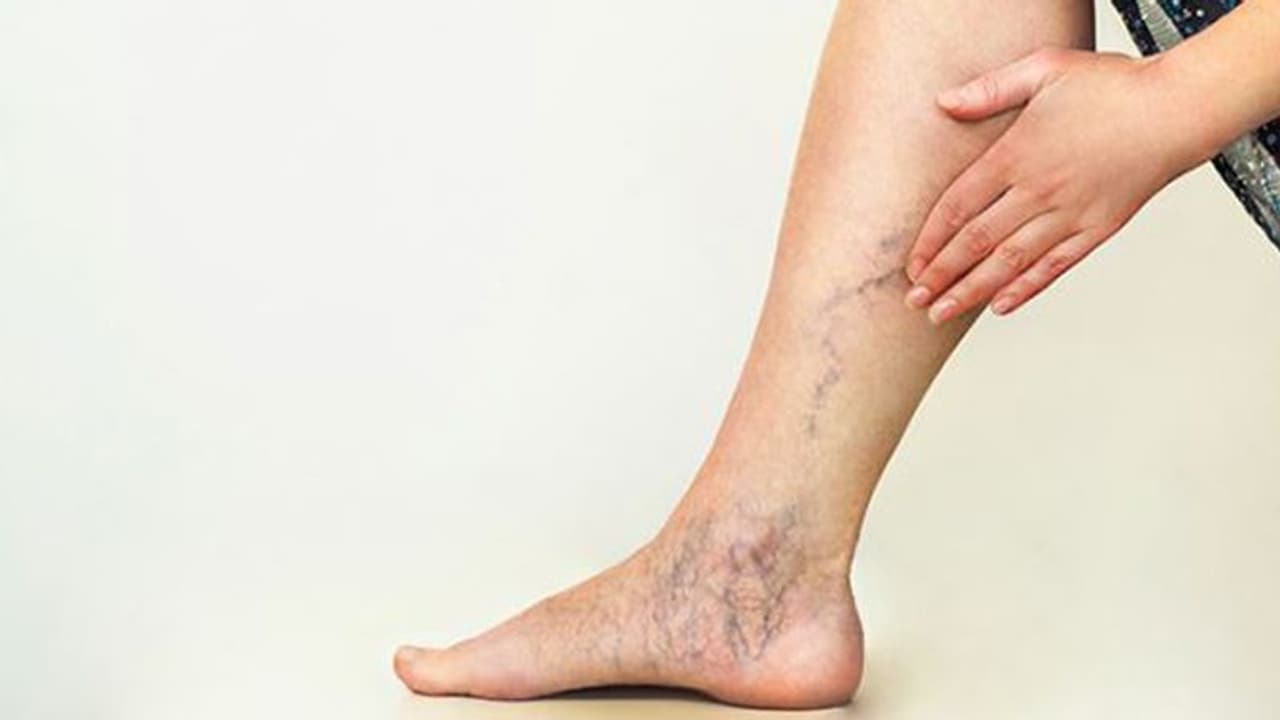 ഈ അഞ്ച് കാര്യങ്ങൾ ശ്രദ്ധിച്ചാൽ വെരിക്കോസ് വെയിൻ തടയാം ഈ അഞ്ച് കാര്യങ്ങൾ ശ്രദ്ധിച്ചാൽ വെരിക്കോസ് വെയിൻ തടയാം