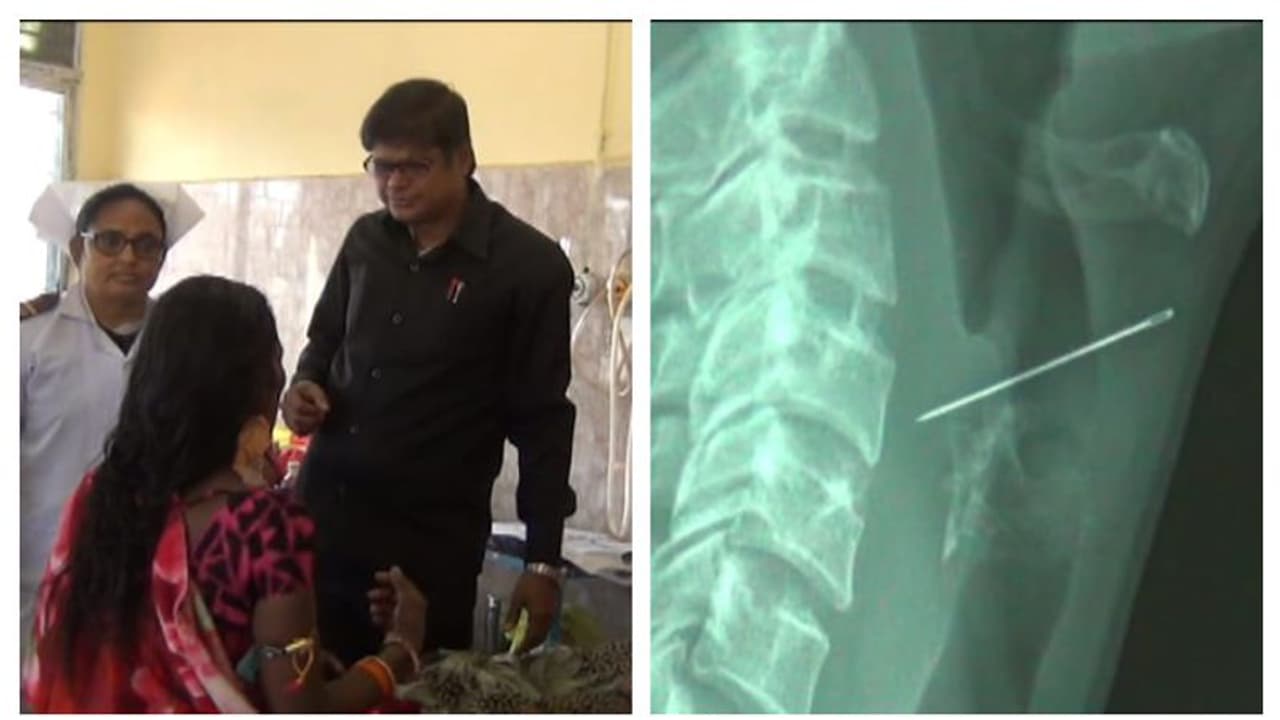 খাদ্যনালীতে বিঁধে সুচ, জটিল অস্ত্রোপচারে প্রাণ বাঁচালেন বাঁকুড়ার চিকিৎসকরা খাদ্যনালীতে বিঁধে সুচ, জটিল অস্ত্রোপচারে প্রাণ বাঁচালেন বাঁকুড়ার চিকিৎসকরা