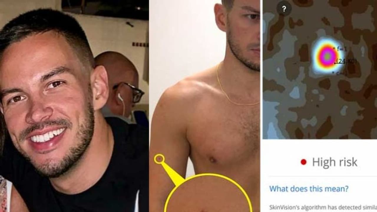 സ്കിന് ക്യാന്സറില് നിന്ന് 31കാരന് രക്ഷപ്പെട്ടത് തന്റെ മൊബൈല് ഫോണിലെ ഒരു ആപ്പിലൂടെ... സ്കിന് ക്യാന്സറില് നിന്ന് 31കാരന് രക്ഷപ്പെട്ടത് തന്റെ മൊബൈല് ഫോണിലെ ഒരു ആപ്പിലൂടെ...