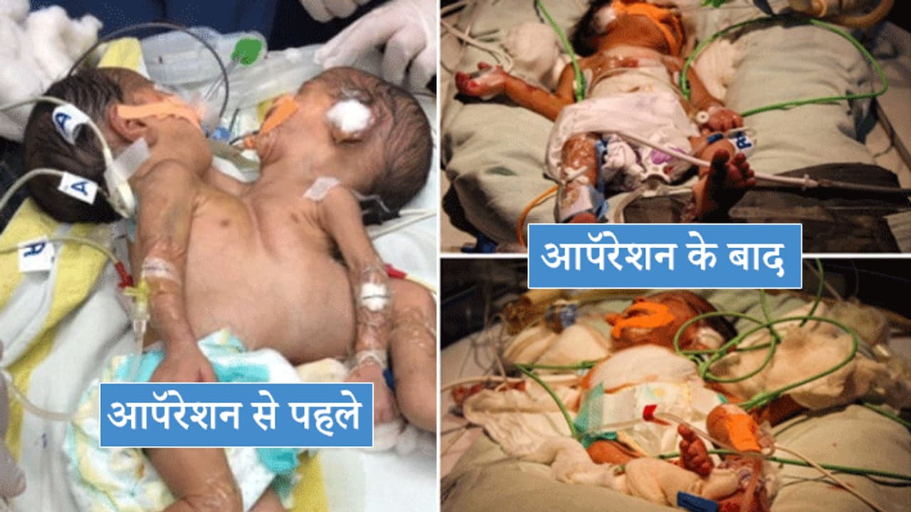 हार्ट और लीवर से जुड़े हुए 6 दिन के 2 बच्चों को किया अलग अलग, देश में इस तरह का यह पहला ऑपरेशन हार्ट और लीवर से जुड़े हुए 6 दिन के 2 बच्चों को किया अलग अलग, देश में इस तरह का यह पहला ऑपरेशन