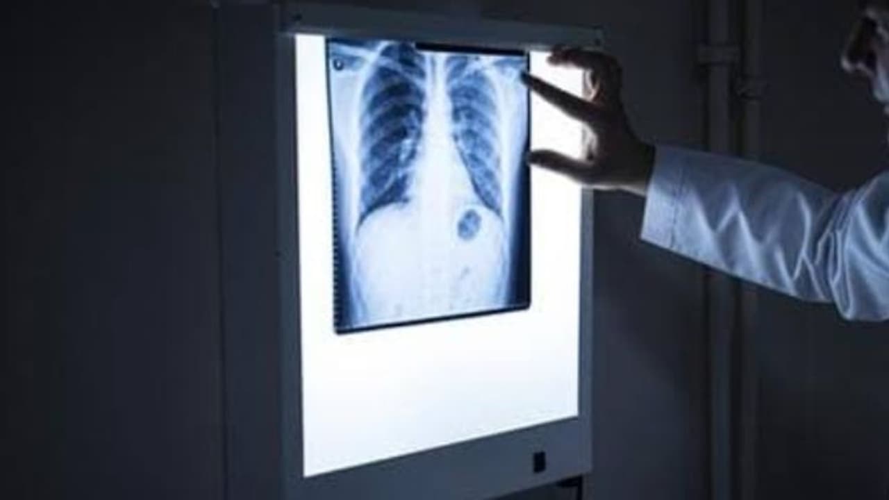 വിട്ടുമാറാത്ത ചുമയുമായി ആശുപത്രിയിലെത്തി, പന്ത്രണ്ടുകാരന്റെ ശ്വാസകോശത്തിൽ കണ്ടെത്തിയത്... വിട്ടുമാറാത്ത ചുമയുമായി ആശുപത്രിയിലെത്തി, പന്ത്രണ്ടുകാരന്റെ ശ്വാസകോശത്തിൽ കണ്ടെത്തിയത്...