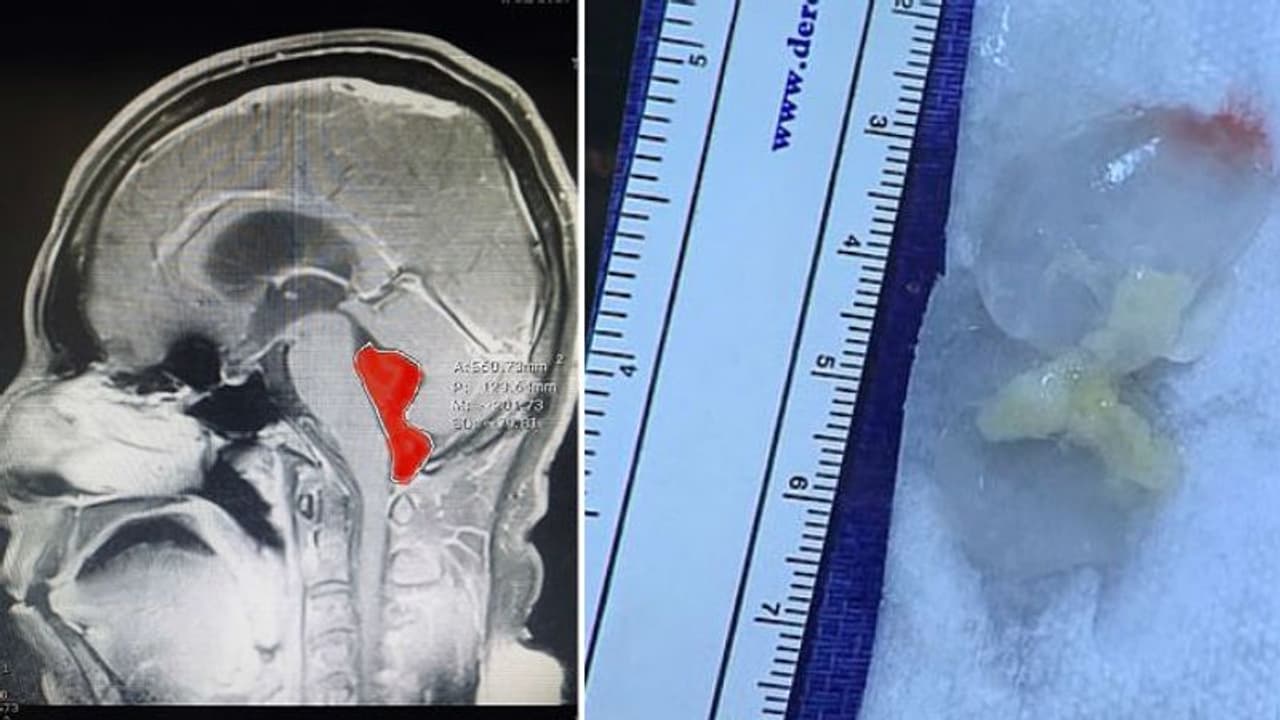 കടുത്ത തലവേദനയും ഛര്ദ്ദിയും; ഒടുവില് തലച്ചോറില് കണ്ടെത്തിയത്... കടുത്ത തലവേദനയും ഛര്ദ്ദിയും; ഒടുവില് തലച്ചോറില് കണ്ടെത്തിയത്...