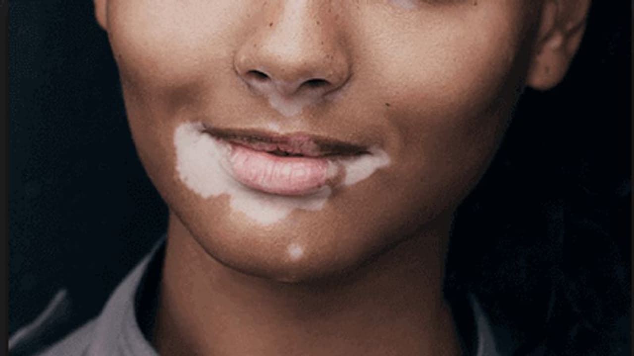 வெண்புள்ளி பிரச்சனைக்கு மருந்து கண்டுபிடிப்பு...! பல ஆண்டு போராட்டத்திற்கு பின் கிடைத்த நிரந்தர தீர்வு..!