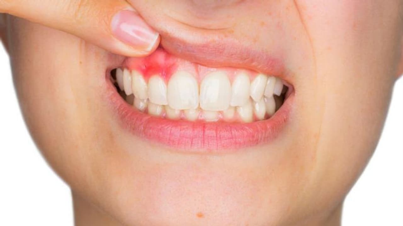 മോണരോഗവും പ്രമേഹവും തമ്മില്‍ ബന്ധം?; പ്രമേഹവുമായി ബന്ധപ്പെട്ട് അറിയേണ്ട 8 കാര്യങ്ങള്‍