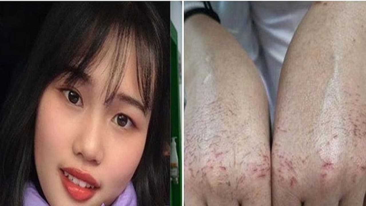 हाथ सूज गए और बहने लगा खून, फिर भी महामारी के शिकार मरीजों की सेवा में दिन रात लगी है यह नर्स हाथ सूज गए और बहने लगा खून, फिर भी महामारी के शिकार मरीजों की सेवा में दिन रात लगी है यह नर्स