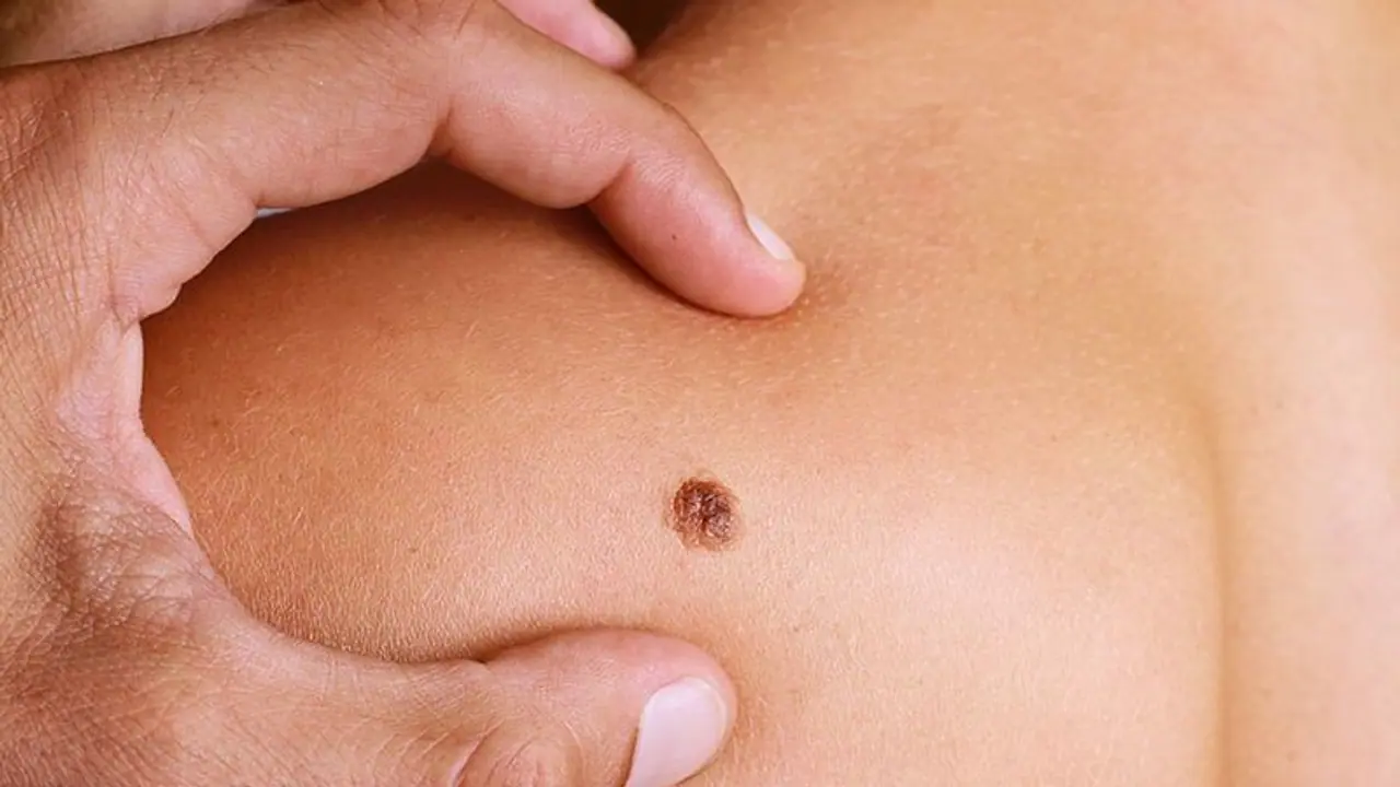 Skin Cancer Symptoms : സ്കിന്‍ ക്യാന്‍സര്‍ ; ഈ ലക്ഷണങ്ങൾ അവ​ഗണിക്കരുത് 