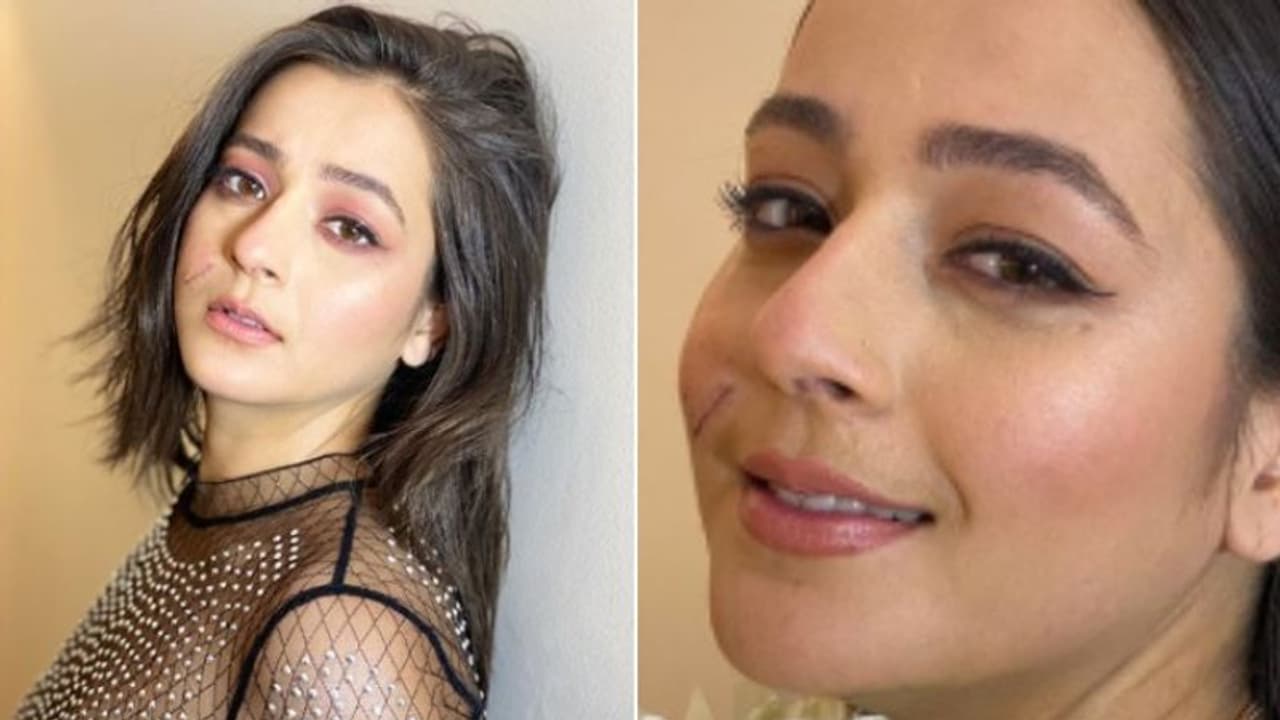 മുഖത്ത് തുന്നിക്കെട്ടുമായി അനാര്‍ക്കലി നായിക; കഴിഞ്ഞ രണ്ട് മാസം വെല്ലുവിളിയേറിയ സമയമായിരുന്നുവെന്നും പ്രിയാല്‍