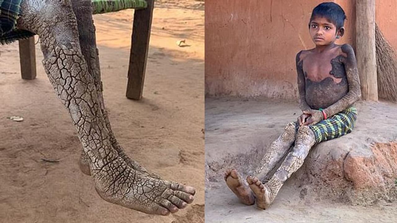 ശരീരം മുഴുവൻ മീന് ചെതുമ്പലിനു സമാനമായ ചര്മം; അപൂര്വ ത്വക്ക് രോഗം ബാധിച്ച് ഏഴു വയസുകാരി ശരീരം മുഴുവൻ മീന് ചെതുമ്പലിനു സമാനമായ ചര്മം; അപൂര്വ ത്വക്ക് രോഗം ബാധിച്ച് ഏഴു വയസുകാരി