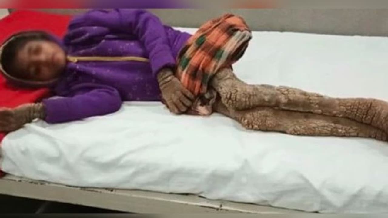 গাছের শুকনো ডালের মত আকার নিল পা, বিরল রোগে আক্রান্ত শিশুকন্যা গাছের শুকনো ডালের মত আকার নিল পা, বিরল রোগে আক্রান্ত শিশুকন্যা