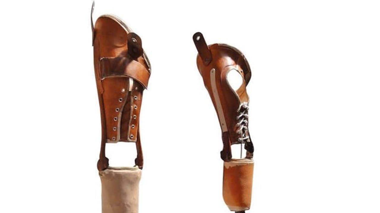 Free instant artificial legs become huge hit in Tamil Nadu’s Nagercoil