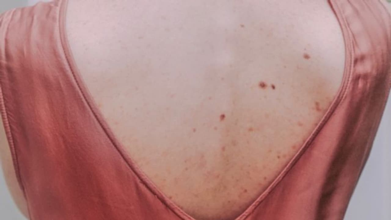 আপনার পিঠেরও একই অবস্থা, আজ থেকে ব্যবহার করুন এই অব্যর্থ টোটকা আপনার পিঠেরও একই অবস্থা, আজ থেকে ব্যবহার করুন এই অব্যর্থ টোটকা