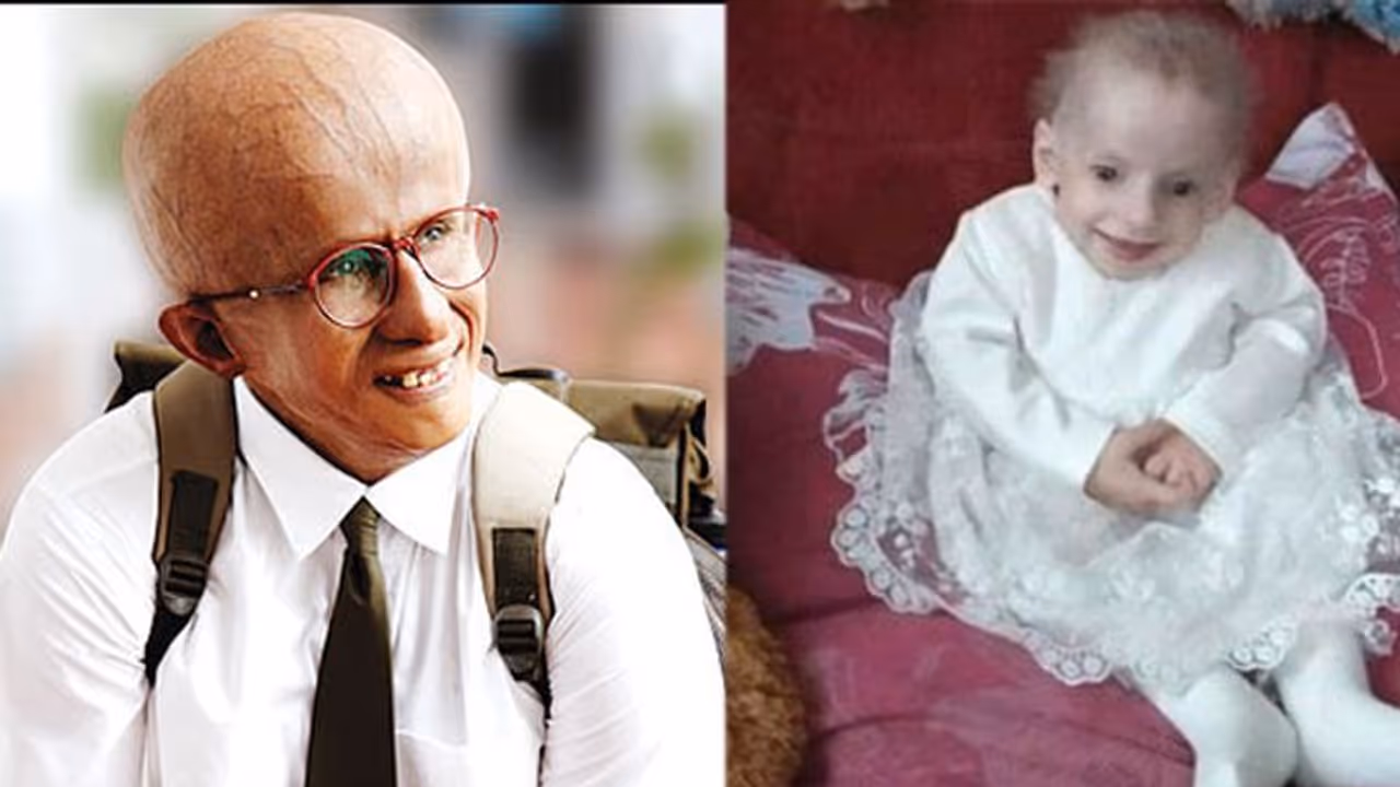 రియల్ లైఫ్‌లో ‘‘పా’’ : 8 ఏళ్లకే 80 ఏళ్ల బామ్మలా.. అరుదైన వ్యాధితో కన్నుమూసిన చిన్నారి