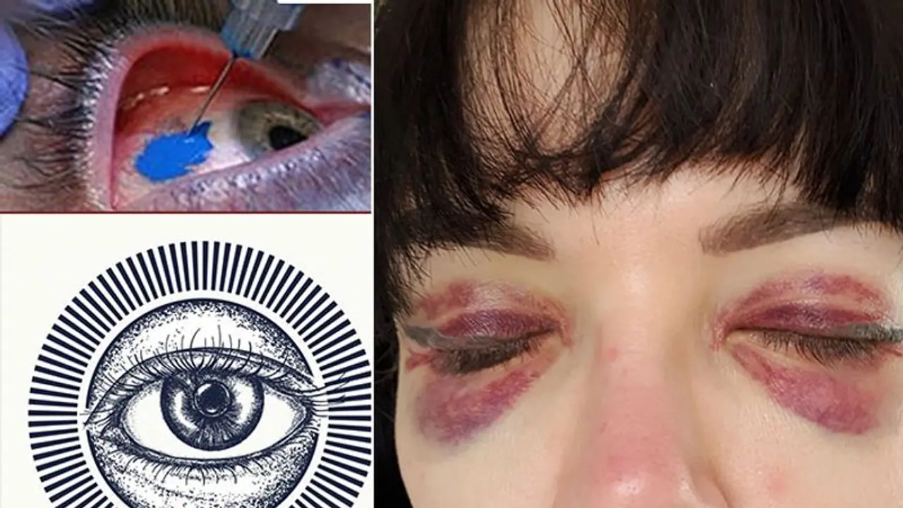 Girl tattoos eyeballs; goes blind trying to copy rapper