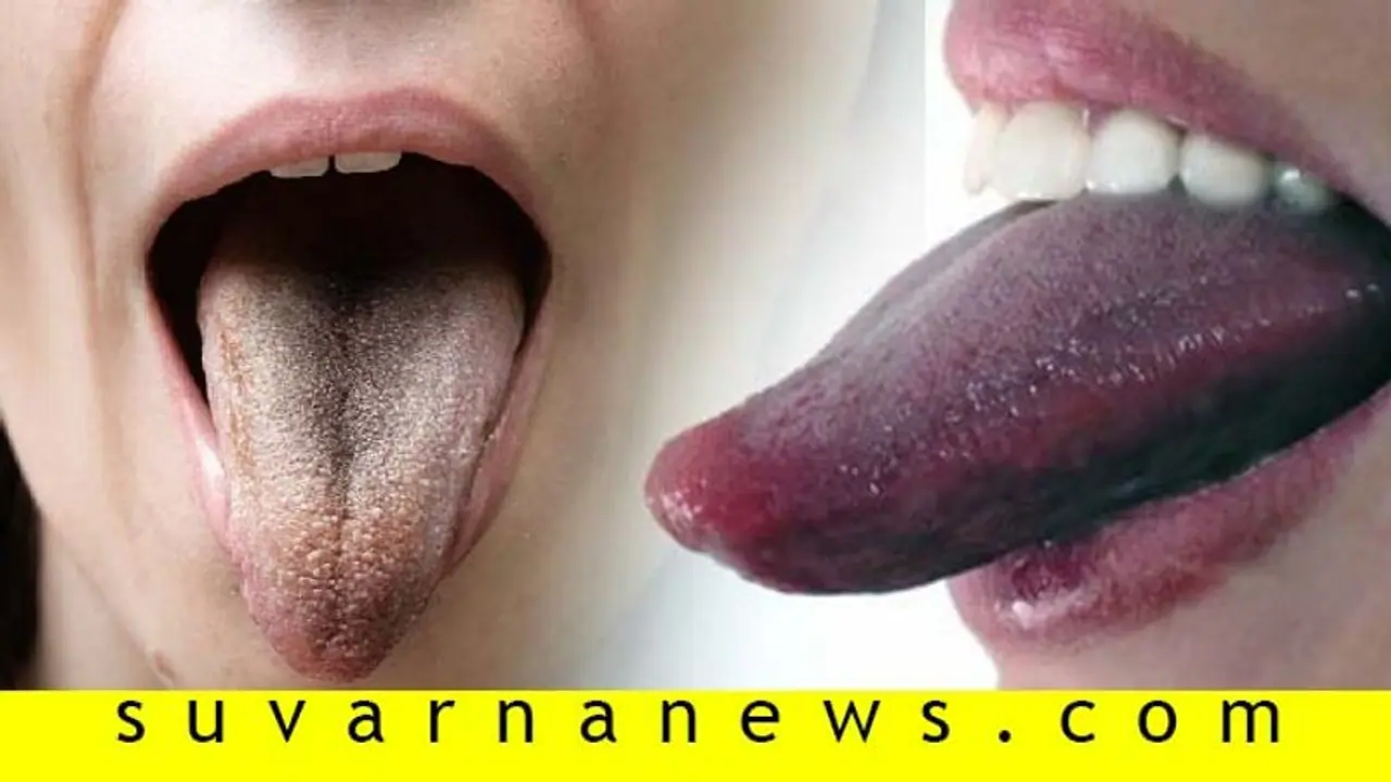 ನಾಲಿಗೆ ಬಣ್ಣವೇ ಹೇಳುತ್ತೆ, ಮನುಷ್ಯನ ಆರೋಗ್ಯ?