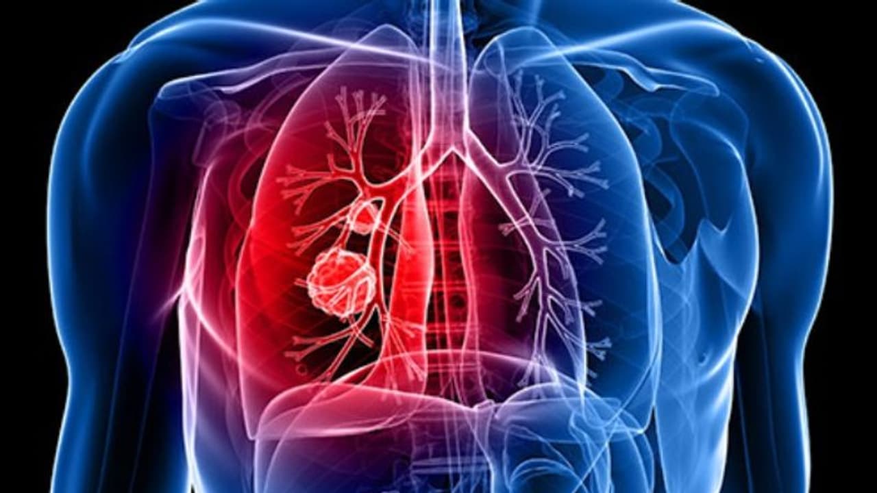 ശ്വാസകോശ കാന്സര്; ഈ ലക്ഷണങ്ങൾ നിസാരമായി കാണരുത് ശ്വാസകോശ കാന്സര്; ഈ ലക്ഷണങ്ങൾ നിസാരമായി കാണരുത്