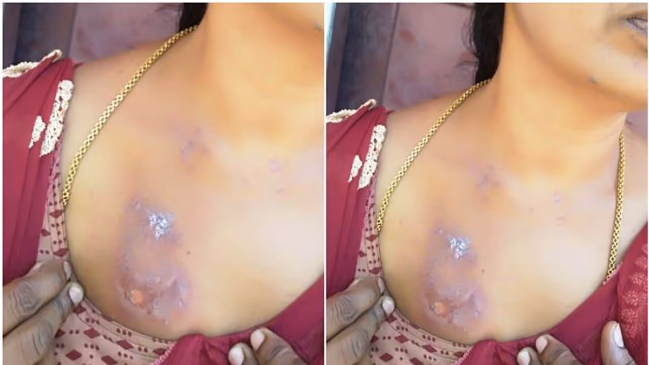 കൊവിഡ് പ്രതിരോധ പ്രവര്‍ത്തനത്തിനിടെ ആരോഗ്യ പ്രവര്‍ത്തകയ്ക്ക് സൂര്യതപമേറ്റു