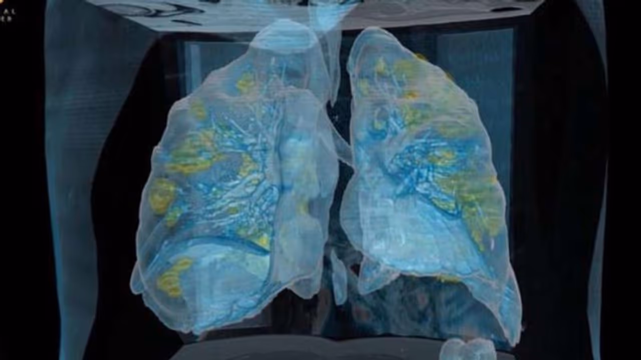 കൊറോണ ബാധിച്ച ആളുടെ ശ്വാസകോശം ഇങ്ങനെയാണ് കൊറോണ ബാധിച്ച ആളുടെ ശ്വാസകോശം ഇങ്ങനെയാണ്