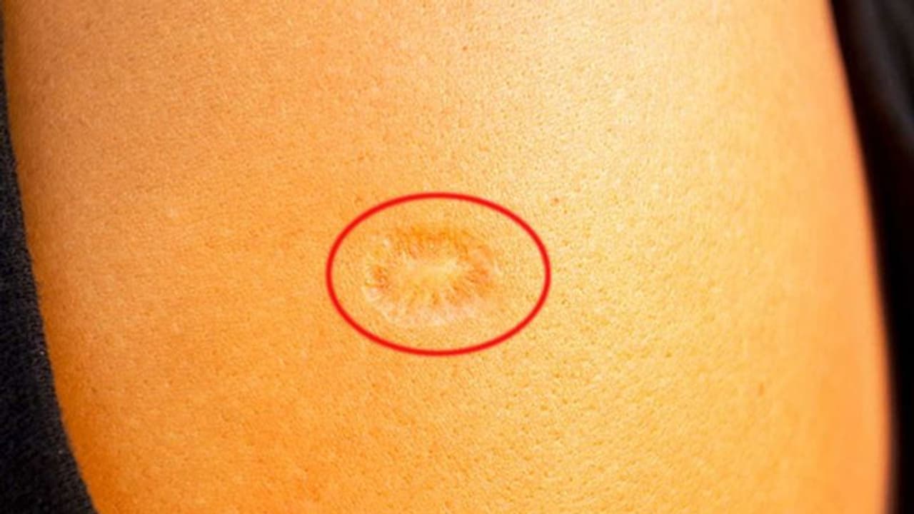 భారతీయుల భుజంపై మచ్చ.. డబ్ల్యూహెచ్వో ప్రయోగాలు: కరోనా నుంచి అదే కాపాడుతోందా..? భారతీయుల భుజంపై మచ్చ.. డబ్ల్యూహెచ్వో ప్రయోగాలు: కరోనా నుంచి అదే కాపాడుతోందా..?