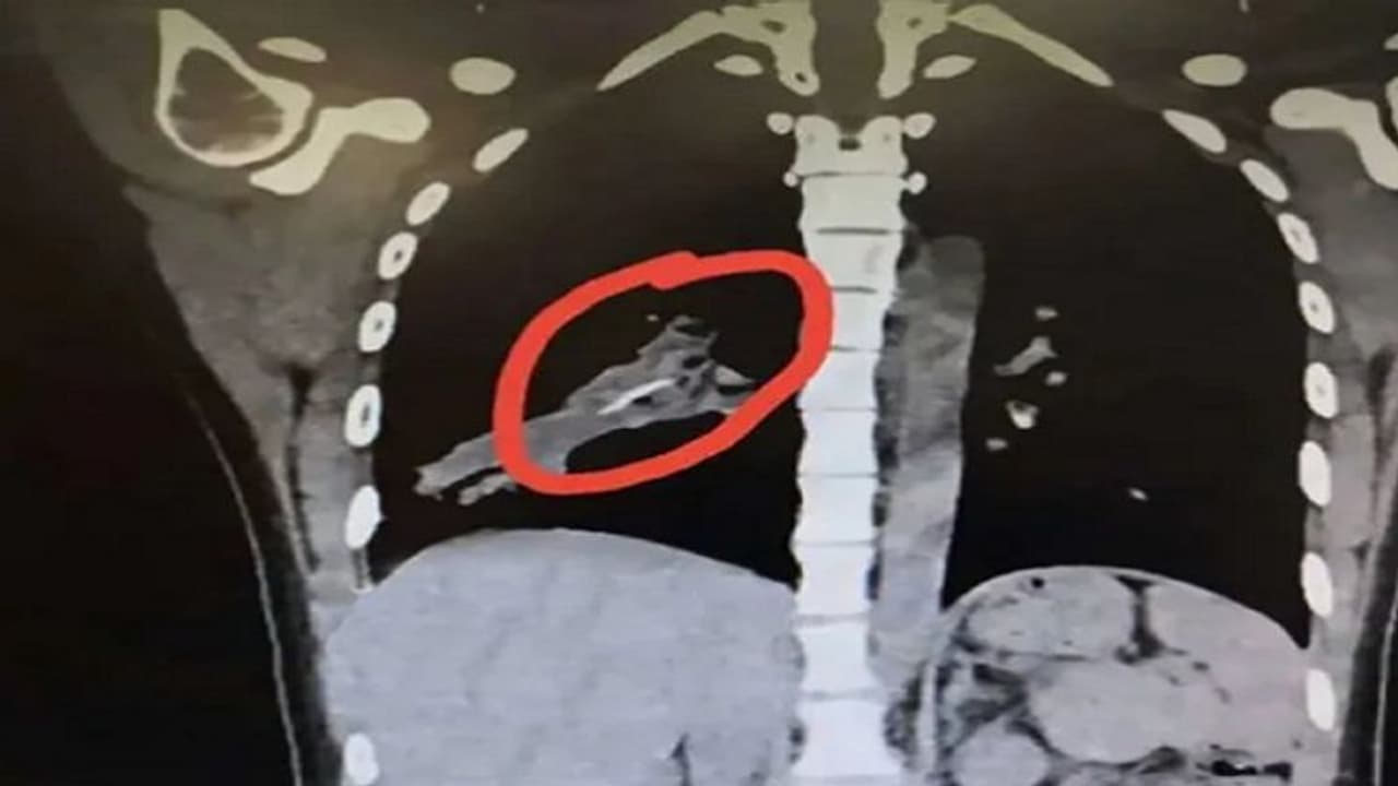 ಮಹಿಳೆ ಶ್ವಾಸಕೋಶದಲ್ಲಿ ಕಂಡುಬಂದ ವಸ್ತು ಕಂಡು ಹೌಹಾರಿದ ಡಾಕ್ಟರ್ಸ್! ಮಹಿಳೆ ಶ್ವಾಸಕೋಶದಲ್ಲಿ ಕಂಡುಬಂದ ವಸ್ತು ಕಂಡು ಹೌಹಾರಿದ ಡಾಕ್ಟರ್ಸ್!