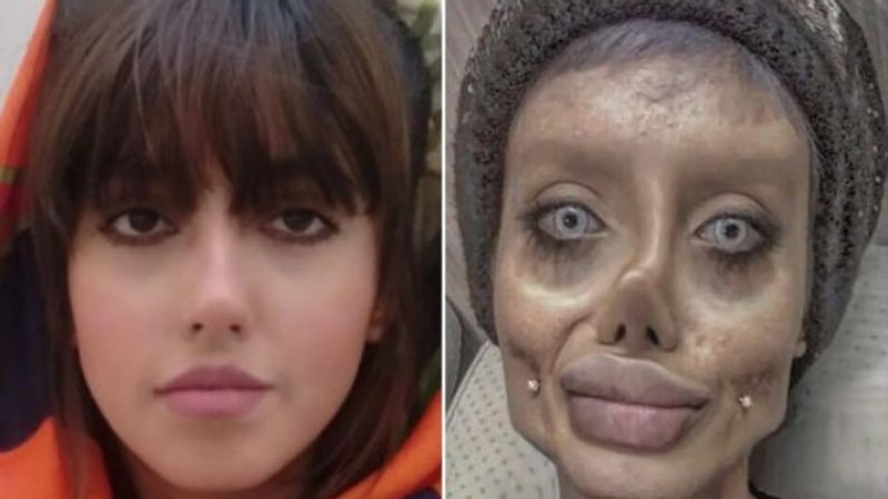 പ്ലാസ്റ്റിക് സര്ജറിയിലൂടെ ആഞ്ജലീന ജോളിയാകാന് ശ്രമിച്ച യുവതി കൊവിഡ് ബാധിച്ച് ഗുരുതരാവസ്ഥയില് പ്ലാസ്റ്റിക് സര്ജറിയിലൂടെ ആഞ്ജലീന ജോളിയാകാന് ശ്രമിച്ച യുവതി കൊവിഡ് ബാധിച്ച് ഗുരുതരാവസ്ഥയില്