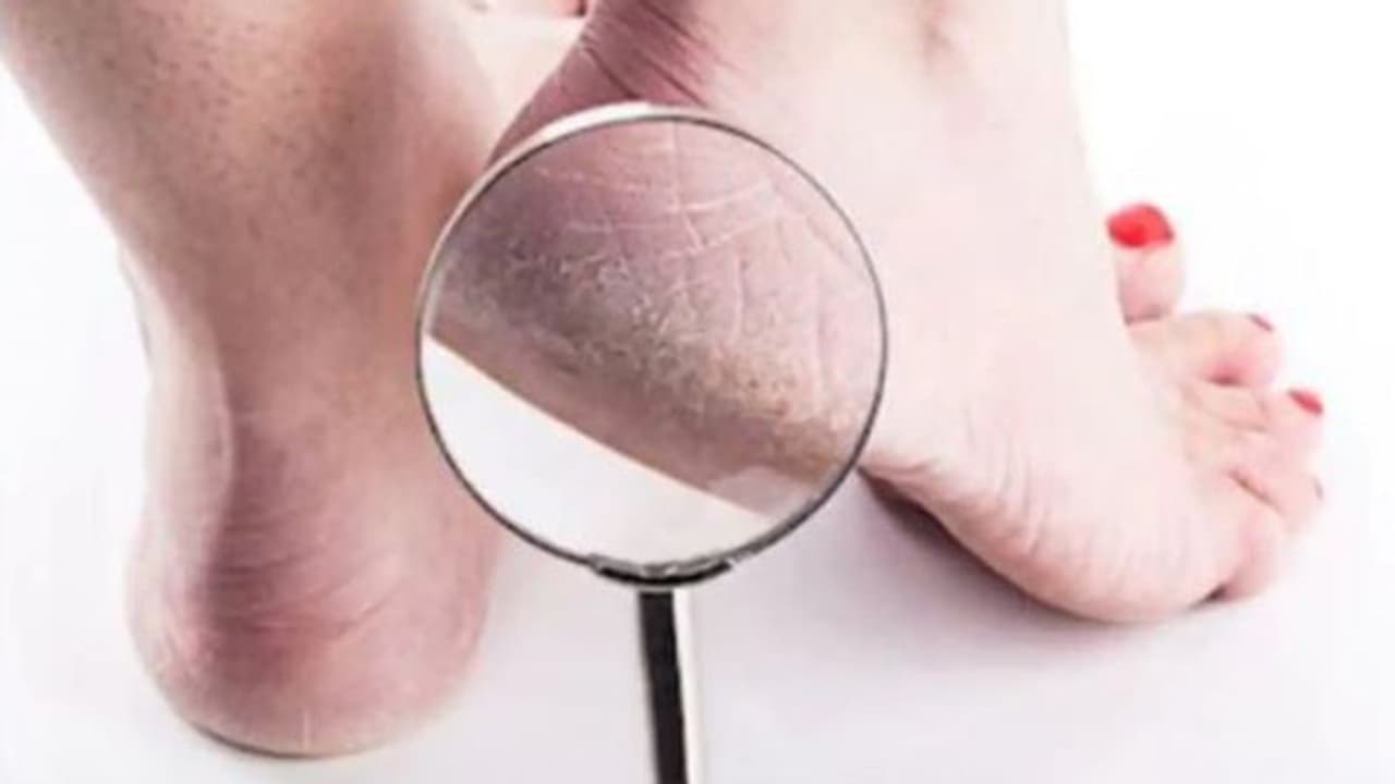 ഉപ്പൂറ്റി വിണ്ടുകീറല്‍; ഇതാ നാല് ഈസി ടിപ്സ്