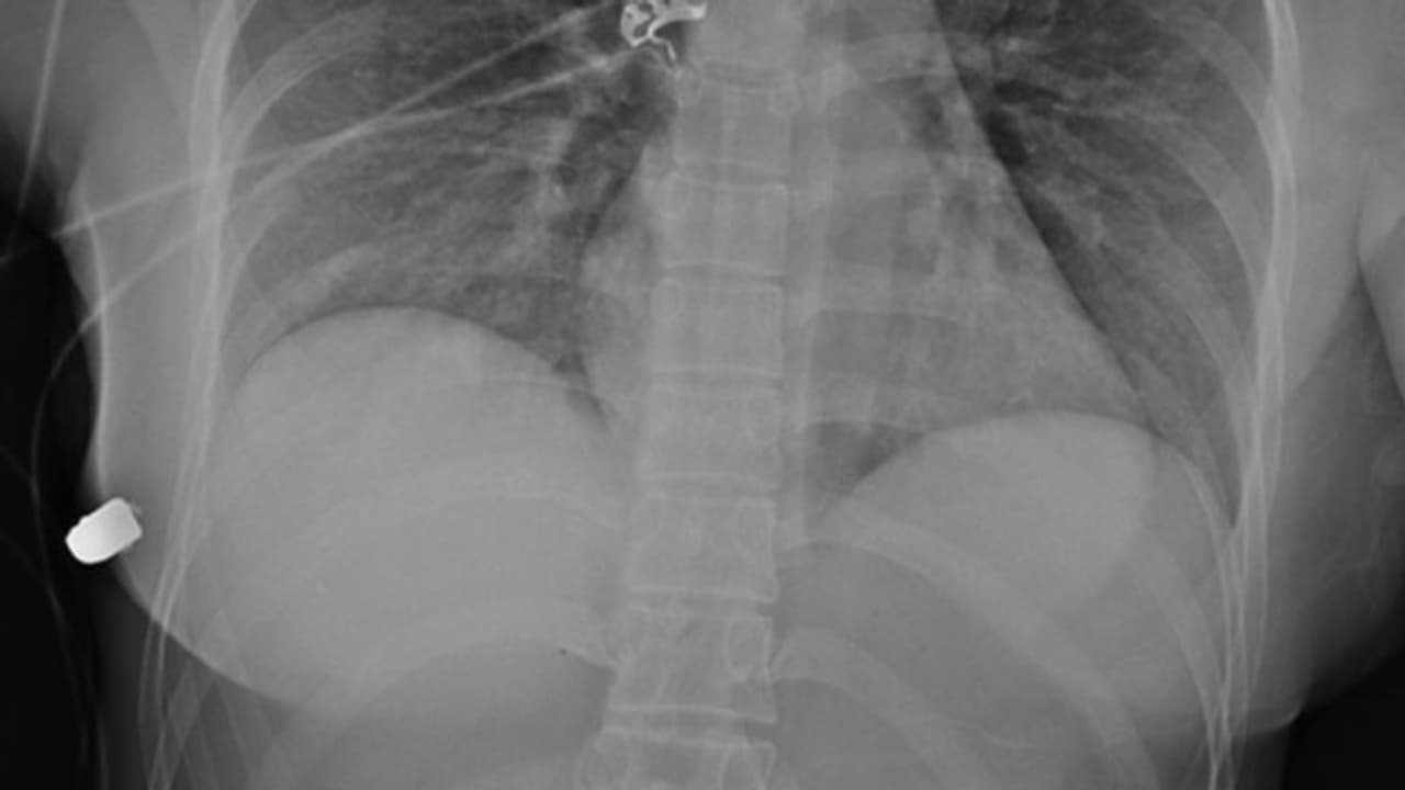 സ്തനത്തില്‍ സിലിക്കണ്‍ ജെല്‍ പിടിപ്പിച്ചത് രക്ഷയായി; യുവതിയുടെ ജീവന്‍ രക്ഷപ്പെട്ടു...