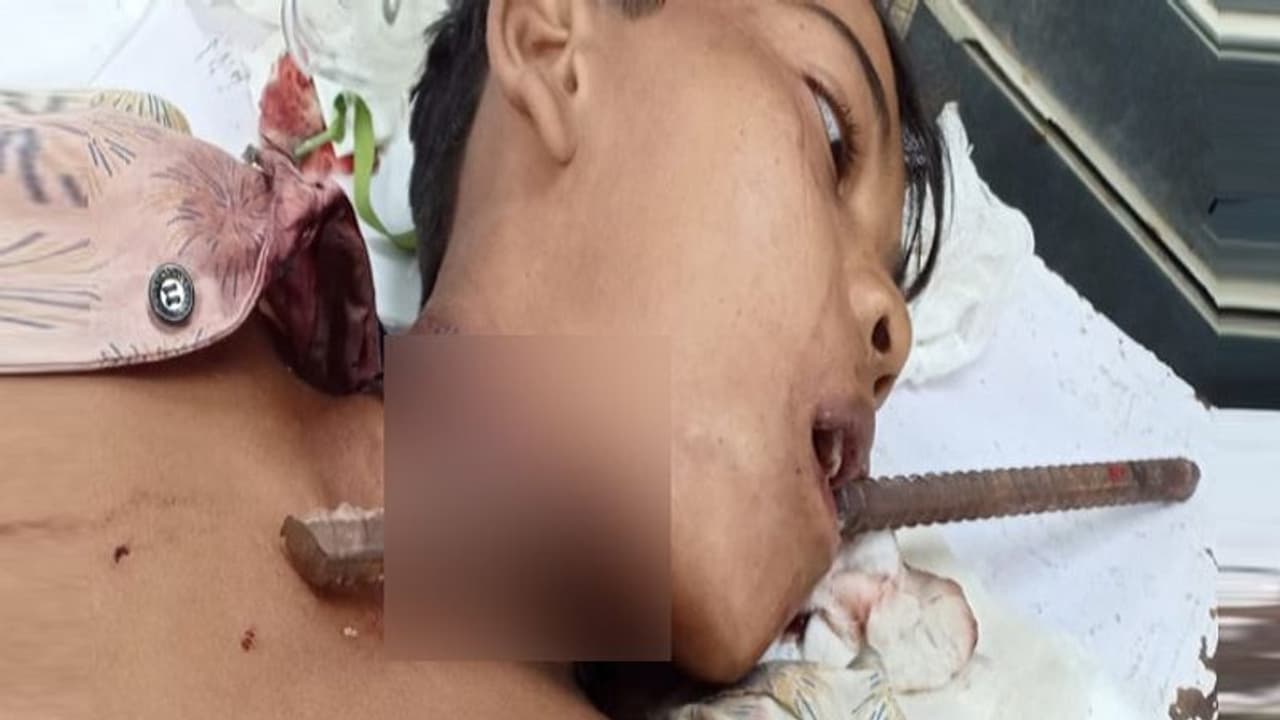 खेल खेल में मुंह के आरपार हुई लोहे की सरिया, डेढ़ घंटे की मशक्कत के बाद बची लड़के की जान खेल खेल में मुंह के आरपार हुई लोहे की सरिया, डेढ़ घंटे की मशक्कत के बाद बची लड़के की जान