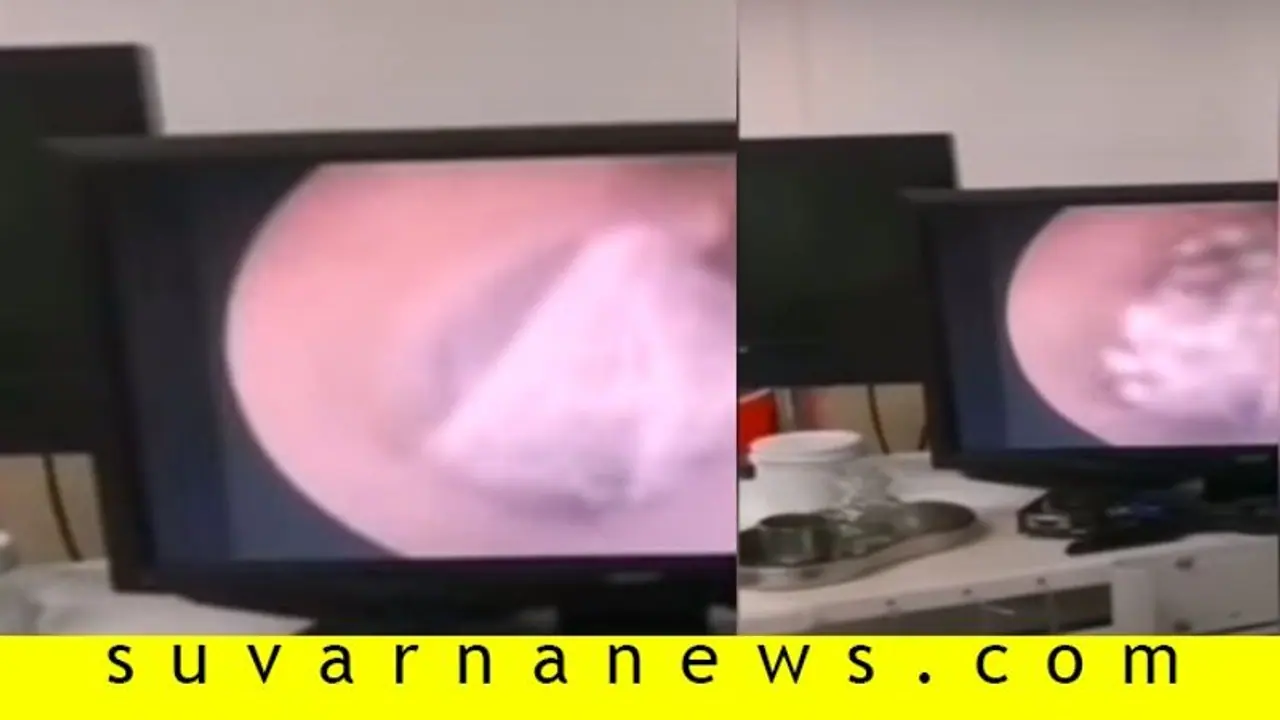 ಕಿವಿಯೊಳಗೆ ಹೊಕ್ಕ ಜೇಡ, ಒಳಗೆ ಹೀಗೆ ಹೆಣೆದಿತ್ತು ಬಲೆ!, ವೈರಲ್ ಆಯ್ತು ವಿಡಿಯೋ