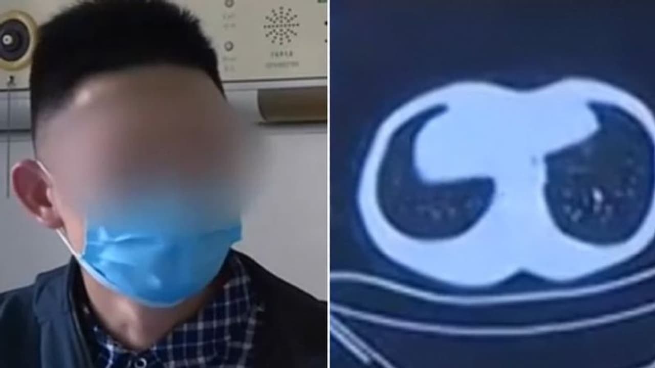 പാകം ചെയ്യാത്ത പാമ്പിനെ ഭക്ഷിച്ചു; ഒടുവില്‍ ശ്വാസകോശത്തിന് പണി കിട്ടി...